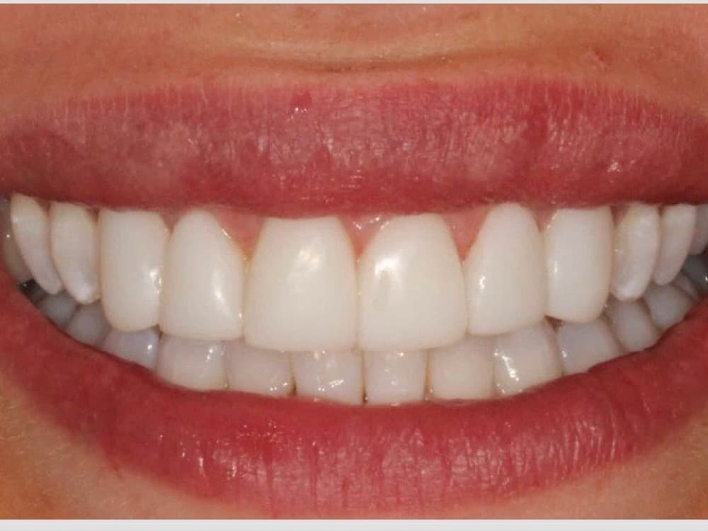 After treatment — A brighter, more even smile