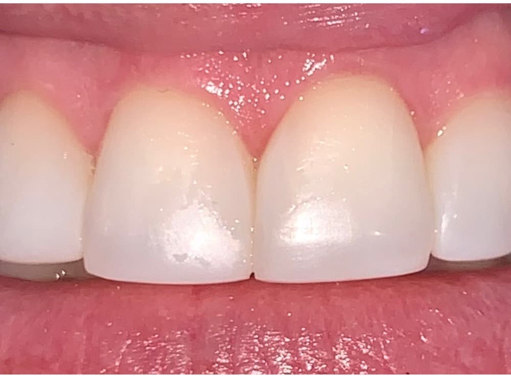 After treatment — Front teeth rebuilt