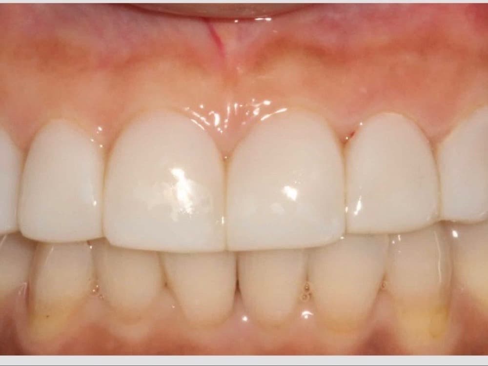 After treatment — A full smile rebuilt