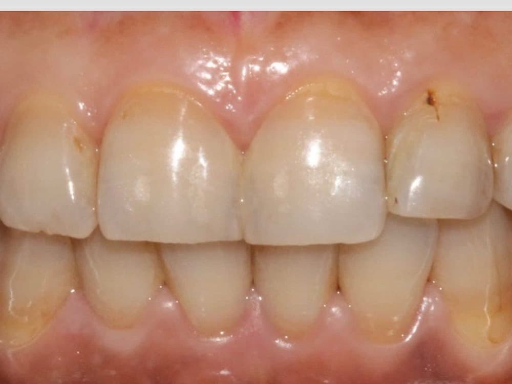 Before treatment — A full smile rebuilt